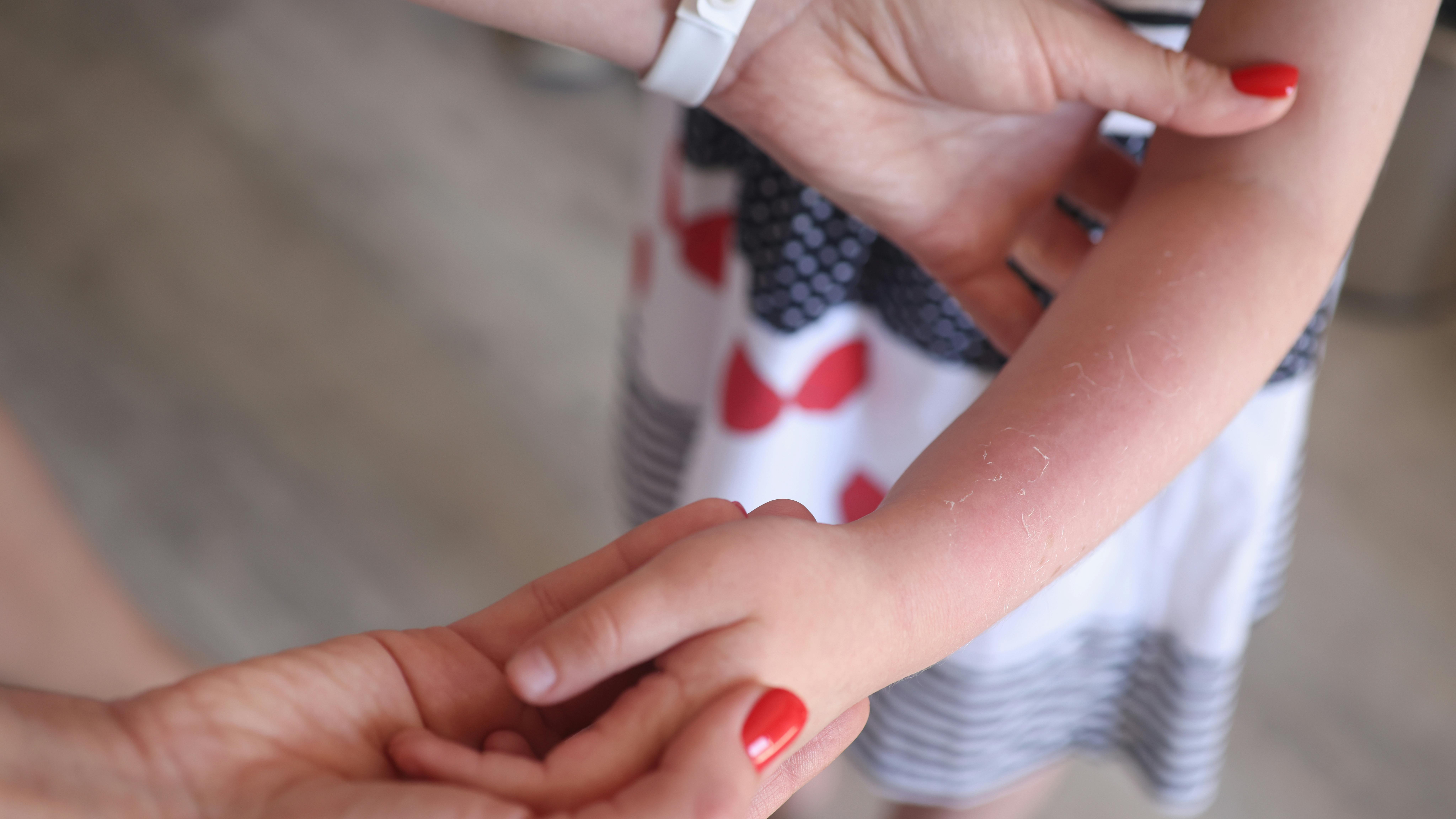 Sunburn redness and peeling of skin on child hand. Baby sunburn and allergy concept