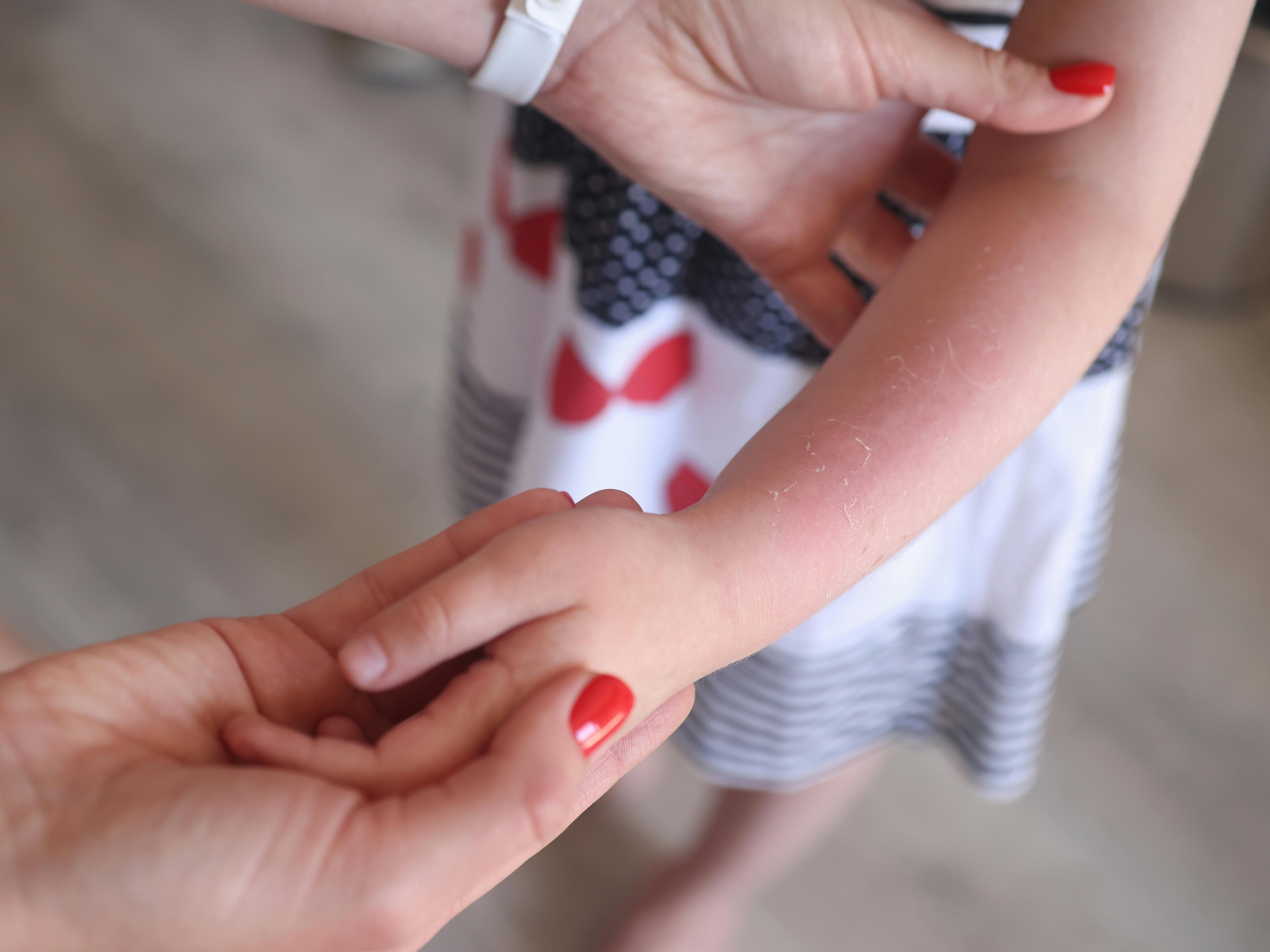 Sunburn redness and peeling of skin on child hand. Baby sunburn and allergy concept