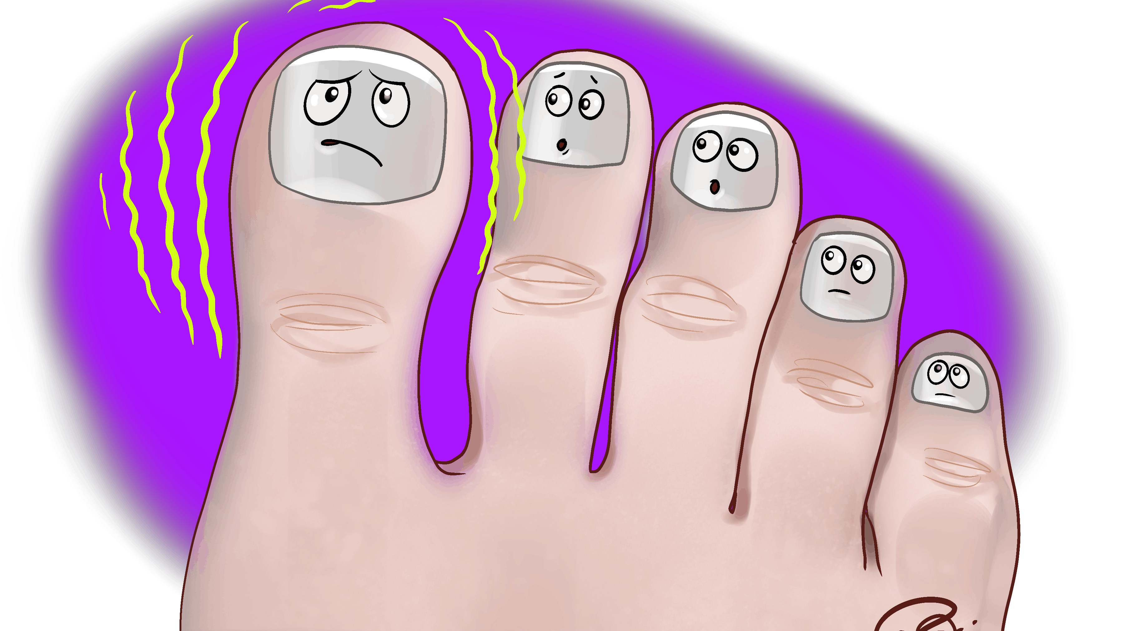 Tånegle, der er nedgroede og gør ondt