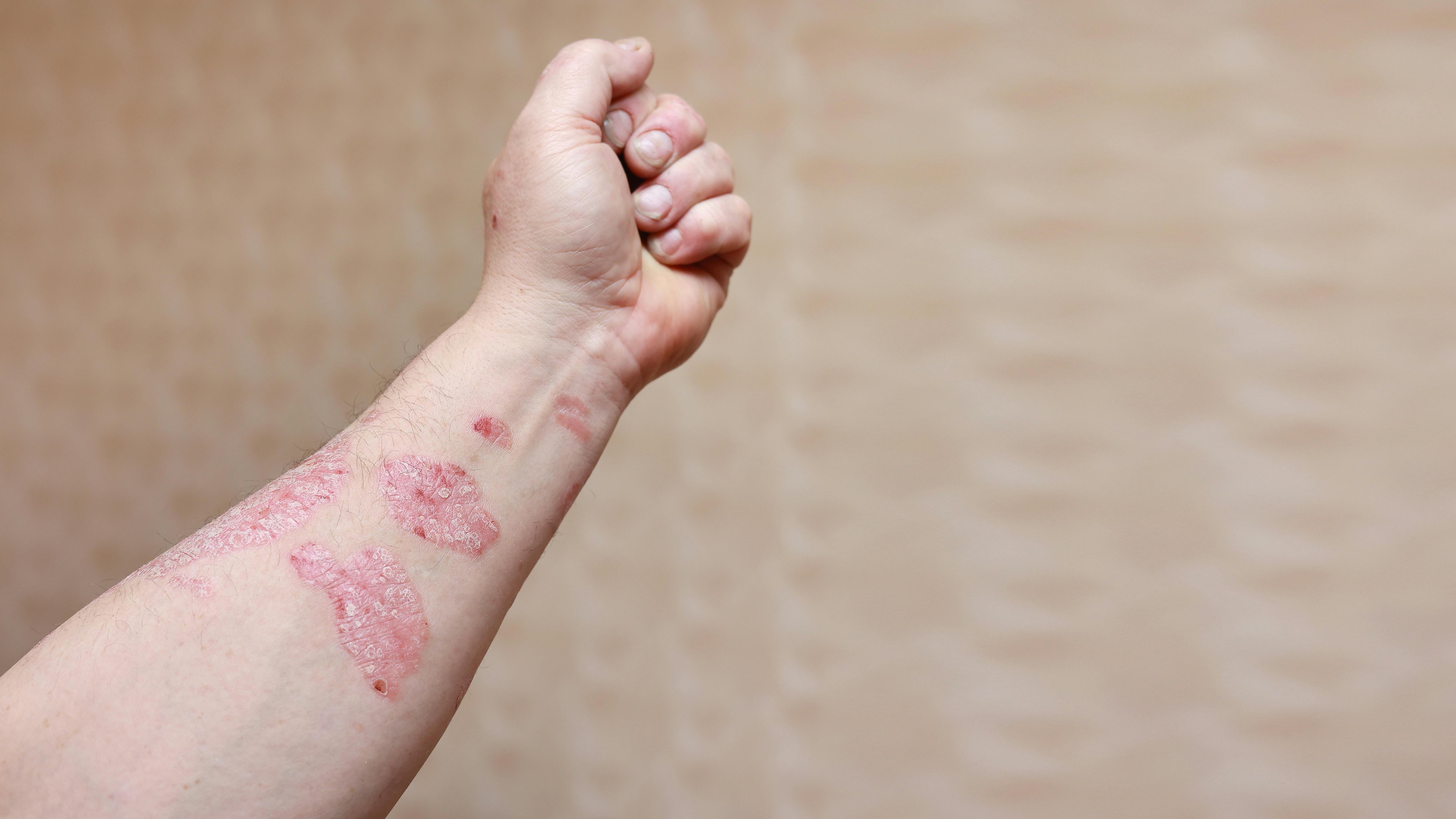 Kvinde med udslæt på armen