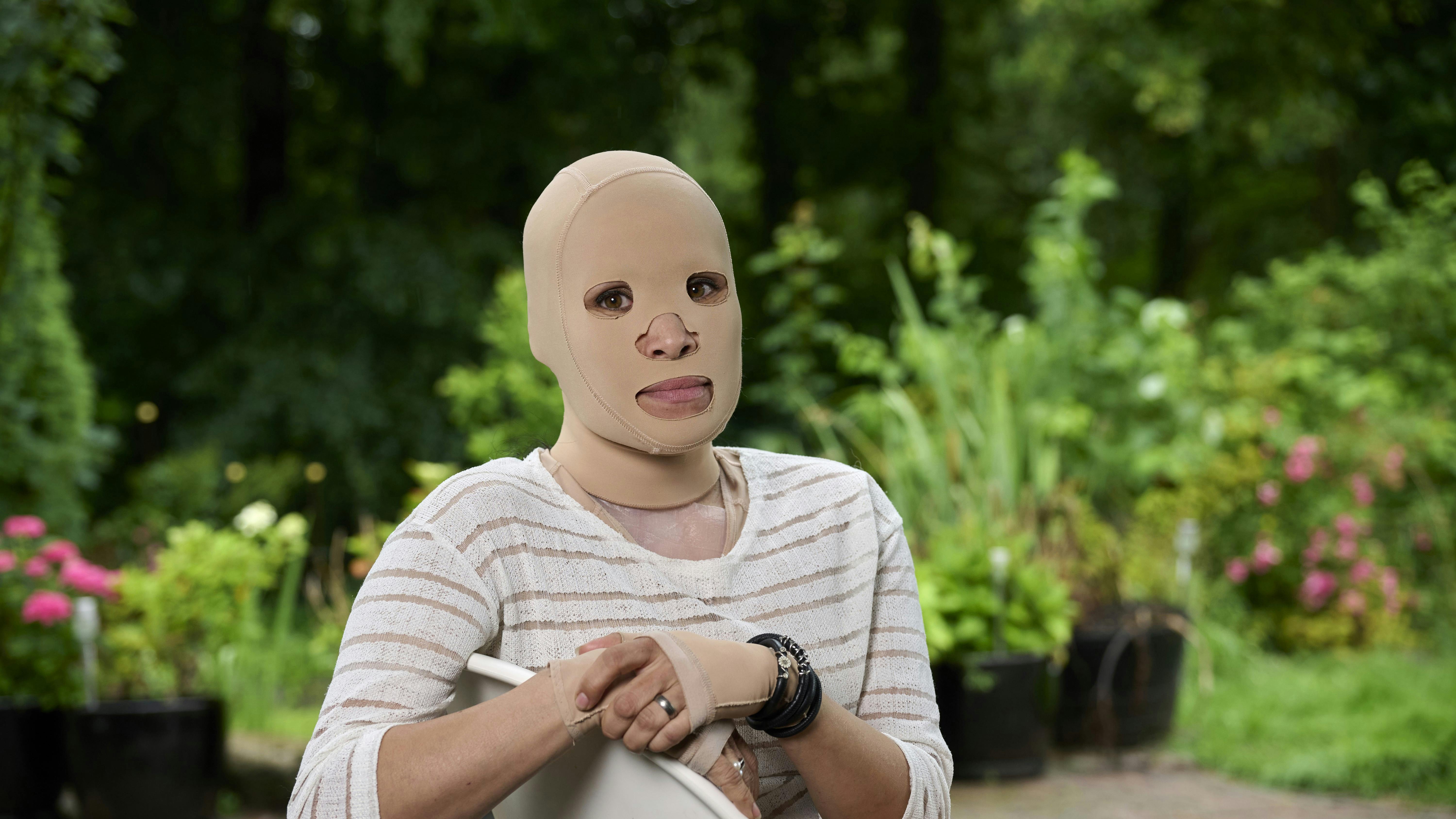 Annemette er iført en heldækkende kompressionsmaske, halskrave og handsker, som hun skulle have på i de første mange måneder efter ulykken døgnet rundt. Først for nyligt har hun sagt endegyldigt farvel til masken.