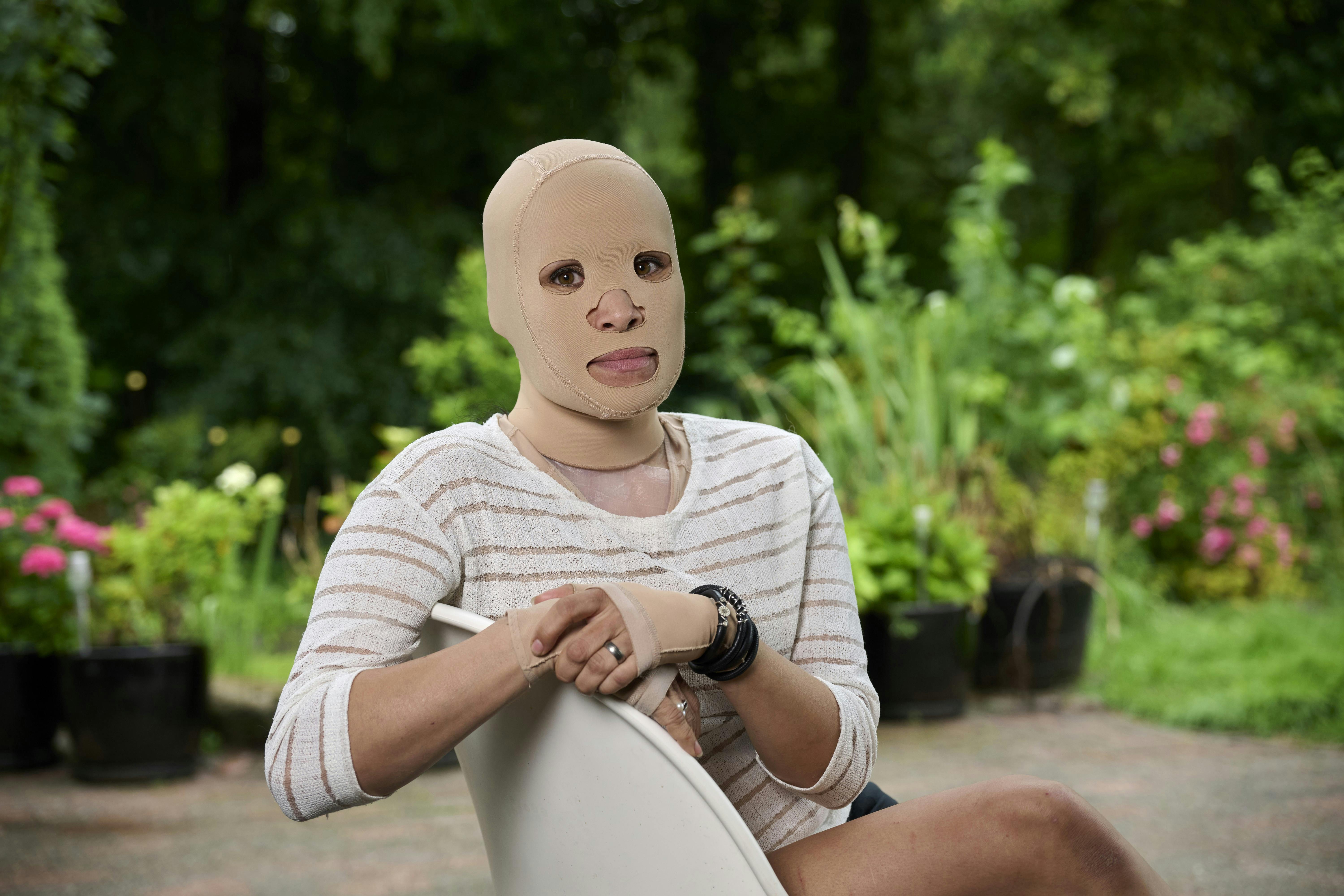 Annemette er iført en maske, fordi hun blev forbrændt af biopejs