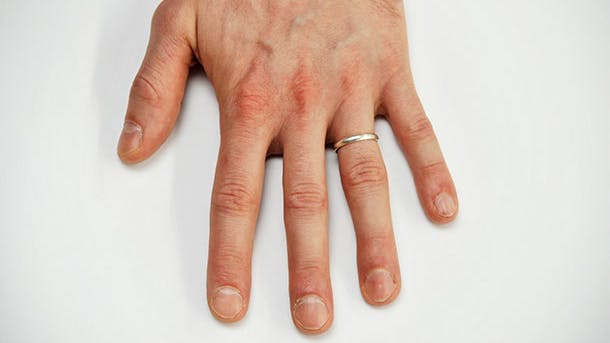 Vitaminmangel afsløres af neglene