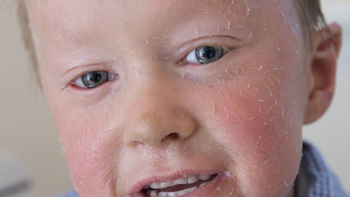 Sune har en sjælden hudsygdom